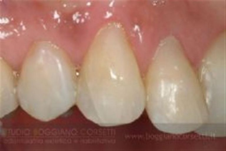Lo sbiancamento dei denti devitalizzati a cura del dott. Giorgio Stori, medico chirurgo odontoiatra